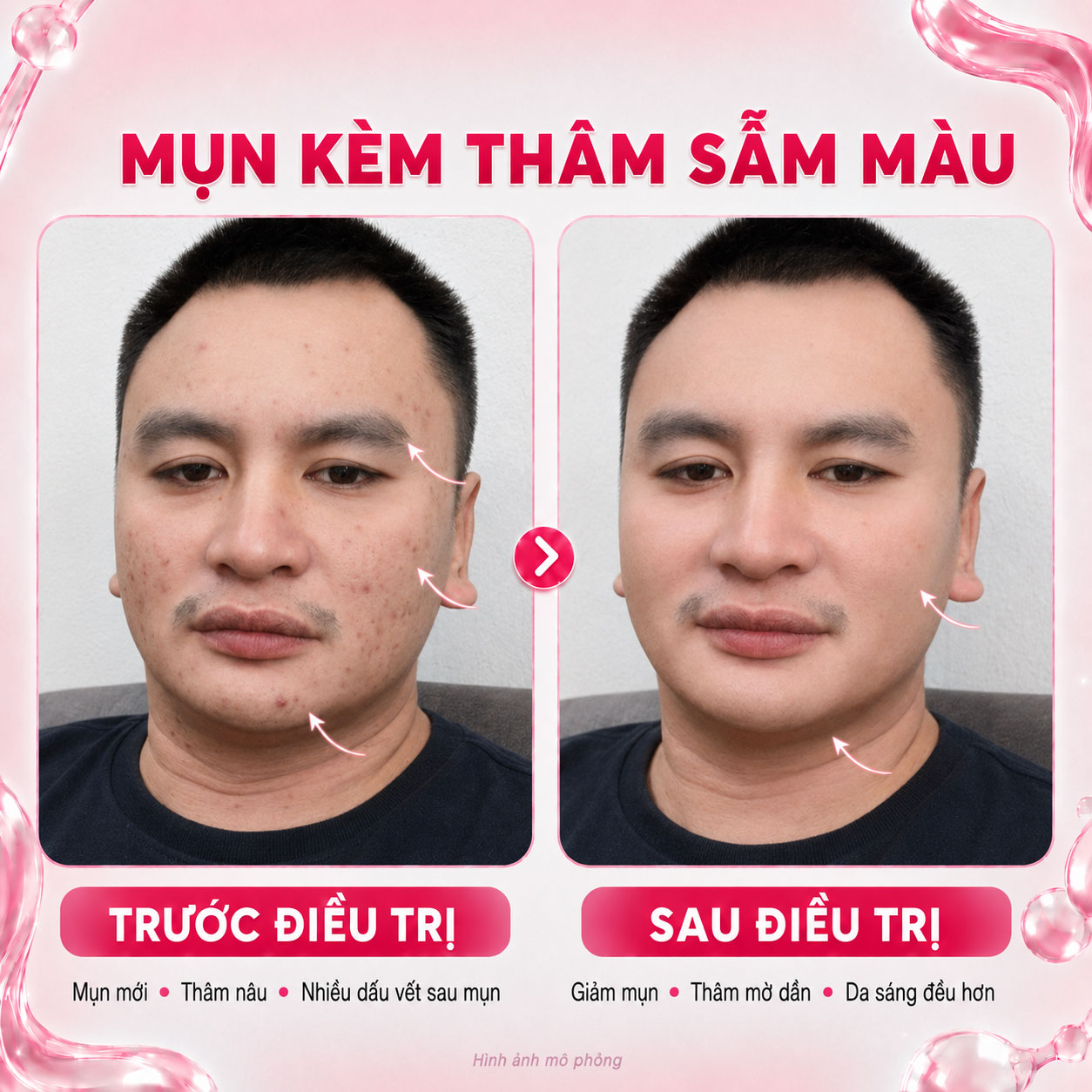 Kết quả trước sau 10