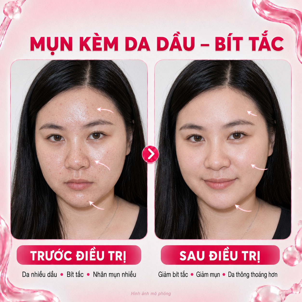 Kết quả trước sau 11