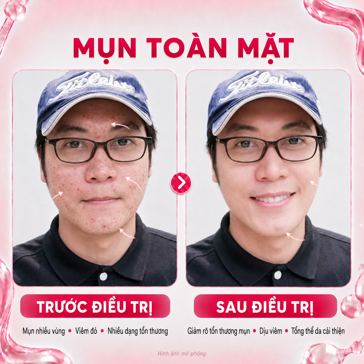 Kết quả trước sau 12