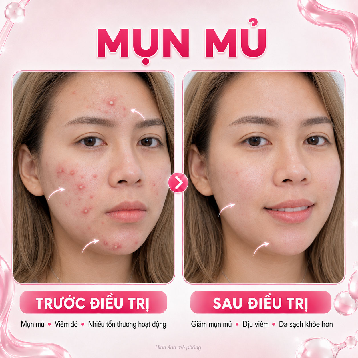 Kết quả trước sau 4