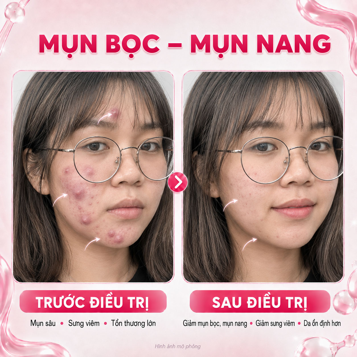 Kết quả trước sau 5