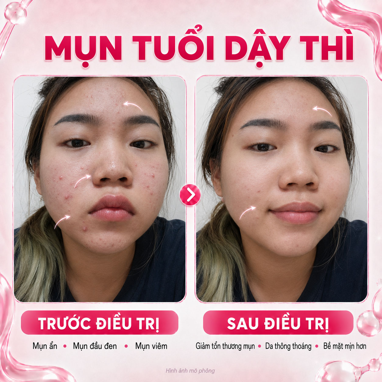 Kết quả trước sau 6