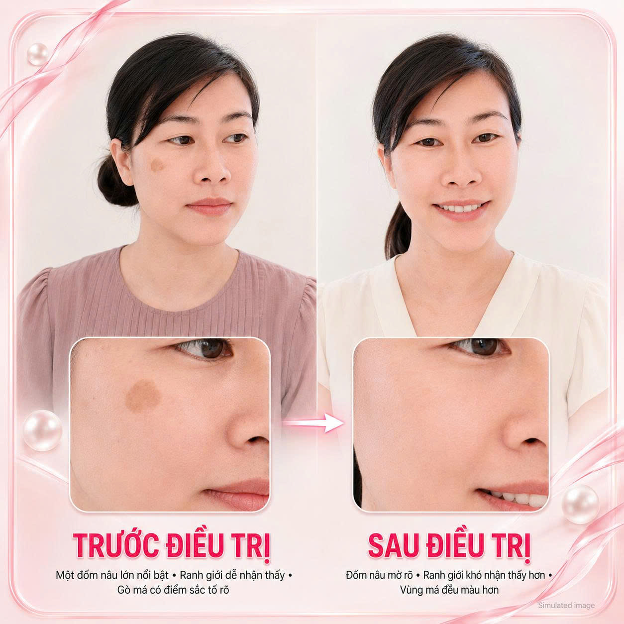 YANG Dynasty Trị Đồi Mồi Case 01
