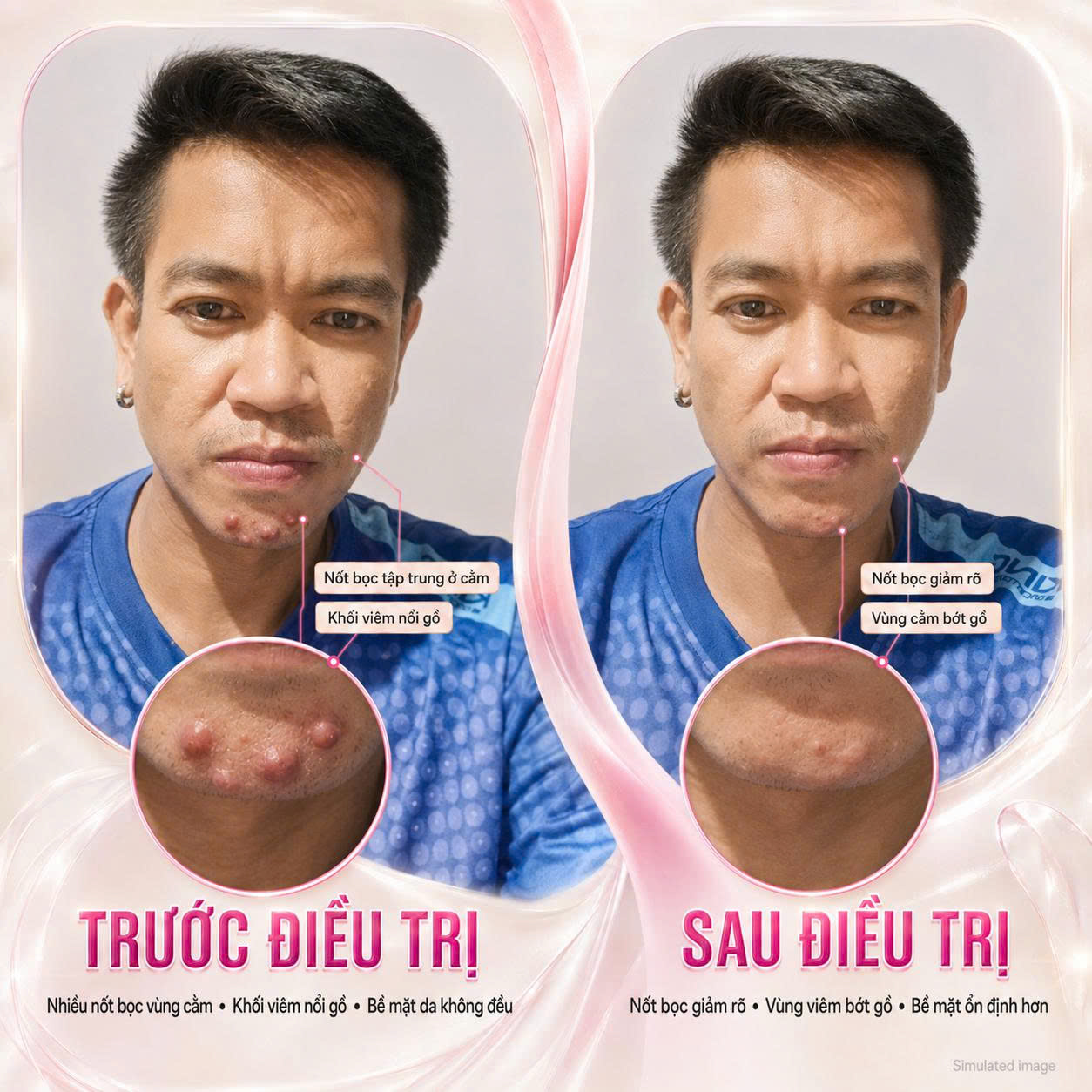 Trị Mụn Bọc Trị Mụn Bọc