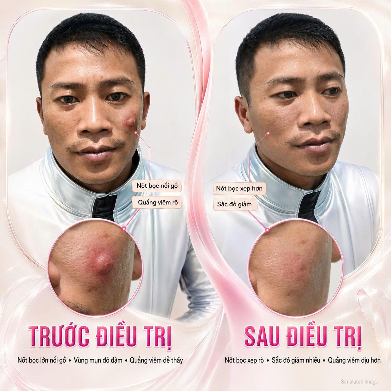 Trị Mụn Bọc Trị Mụn Bọc