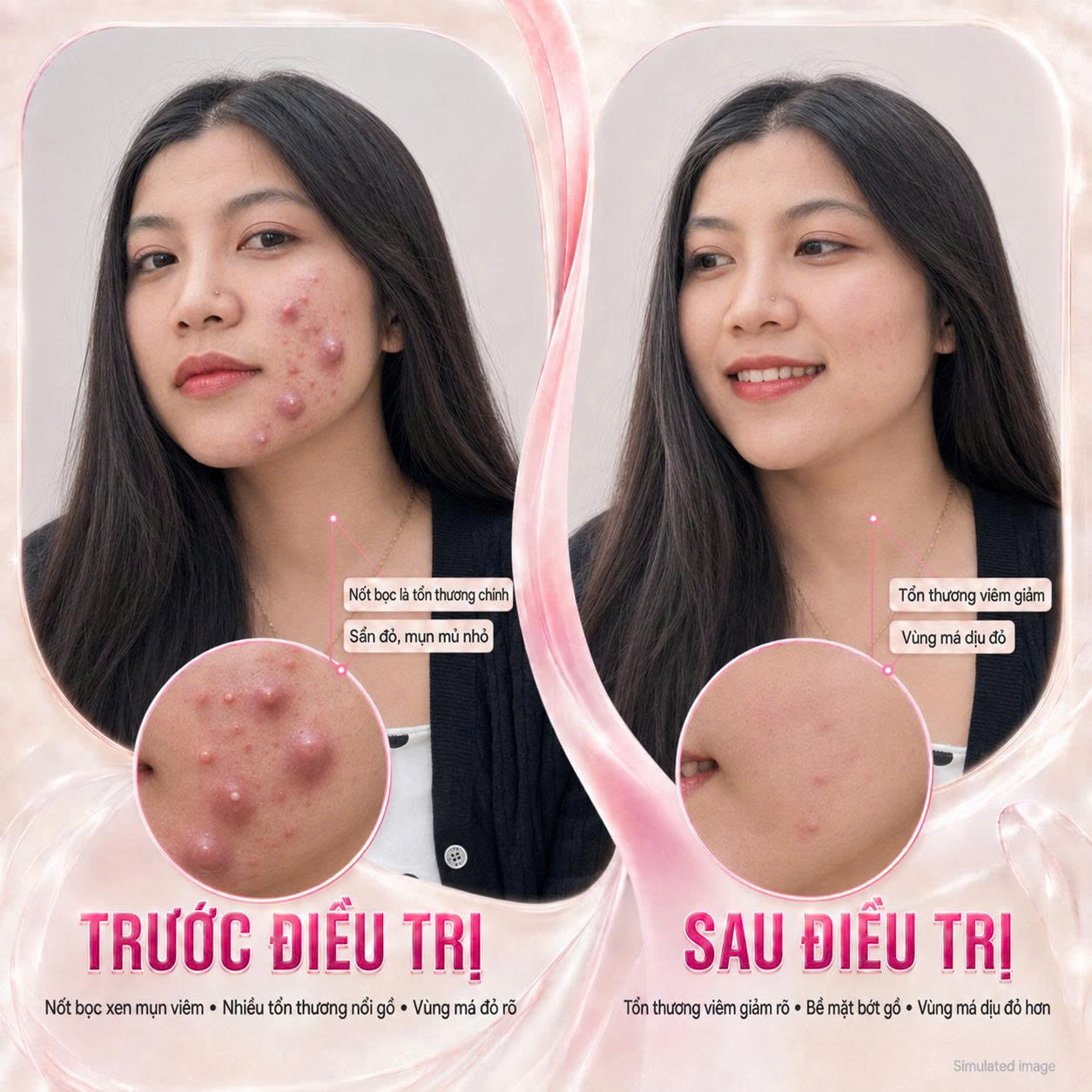 Trị Mụn Bọc Trị Mụn Bọc