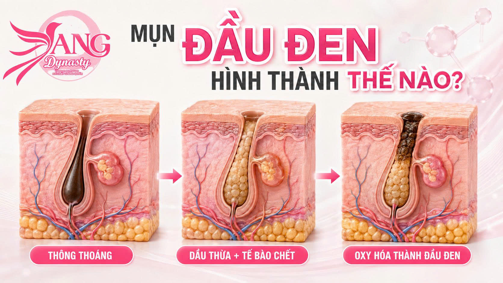 Trị Mụn Đầu Đen Trị Mụn Đầu Đen