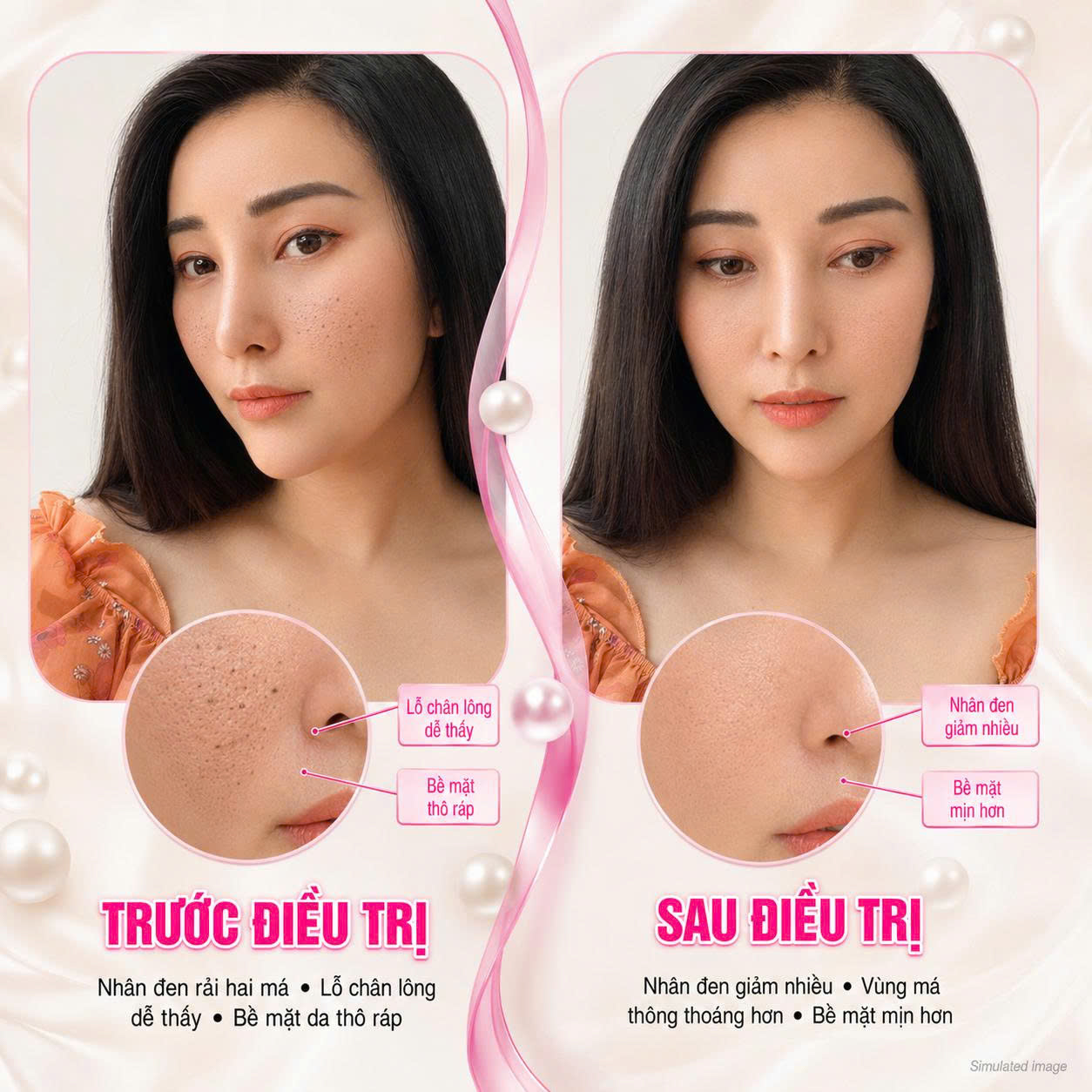 Trị Mụn Đầu Đen Trị Mụn Đầu Đen