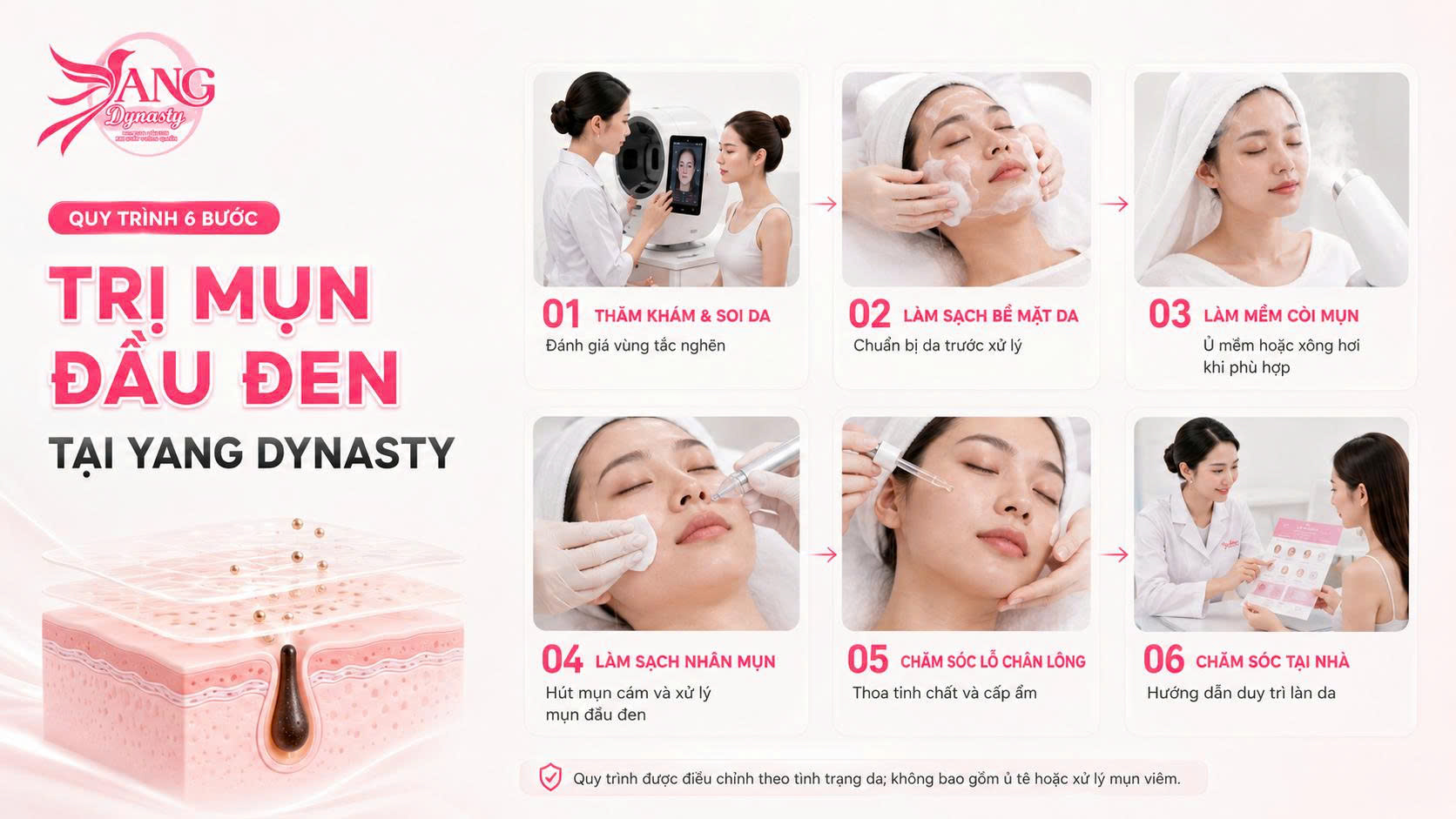 Trị Mụn Đầu Đen