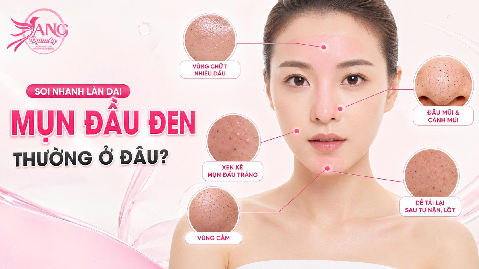 Trị Mụn Đầu Đen Trị Mụn Đầu Đen