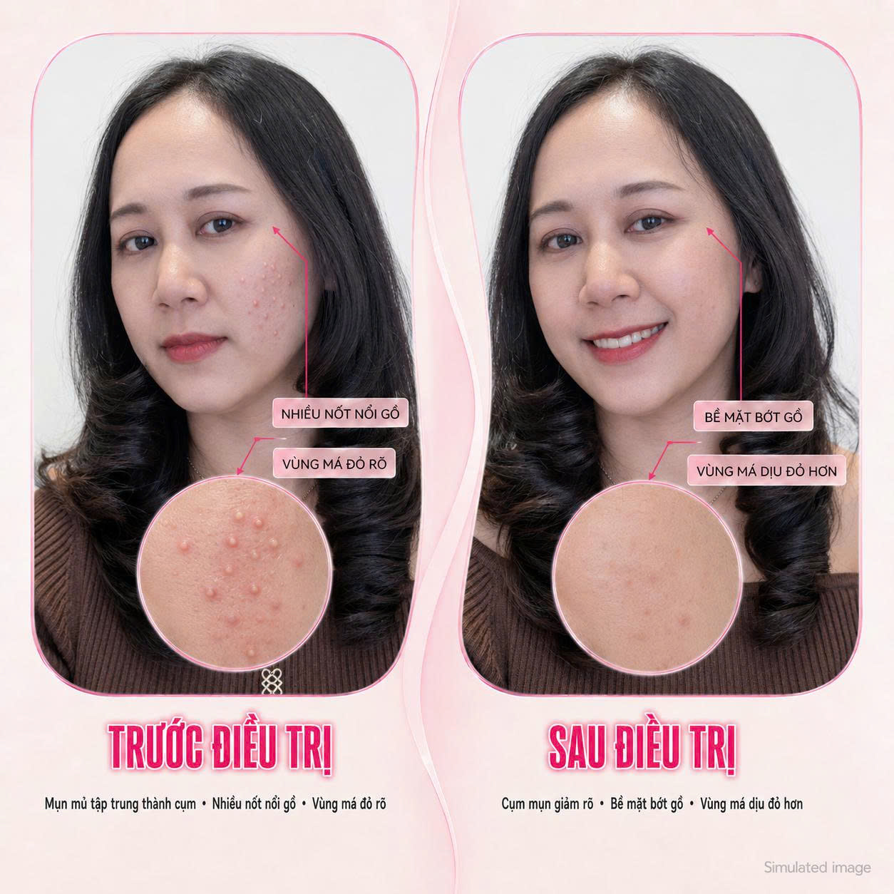 Trị Mụn Mủ Trị Mụn Mủ