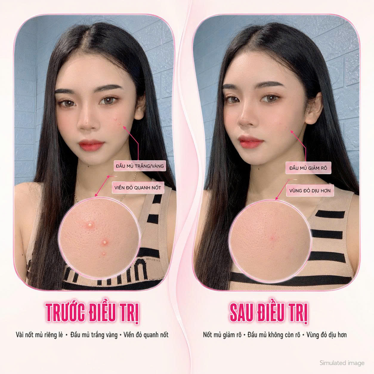 Trị Mụn Mủ Trị Mụn Mủ