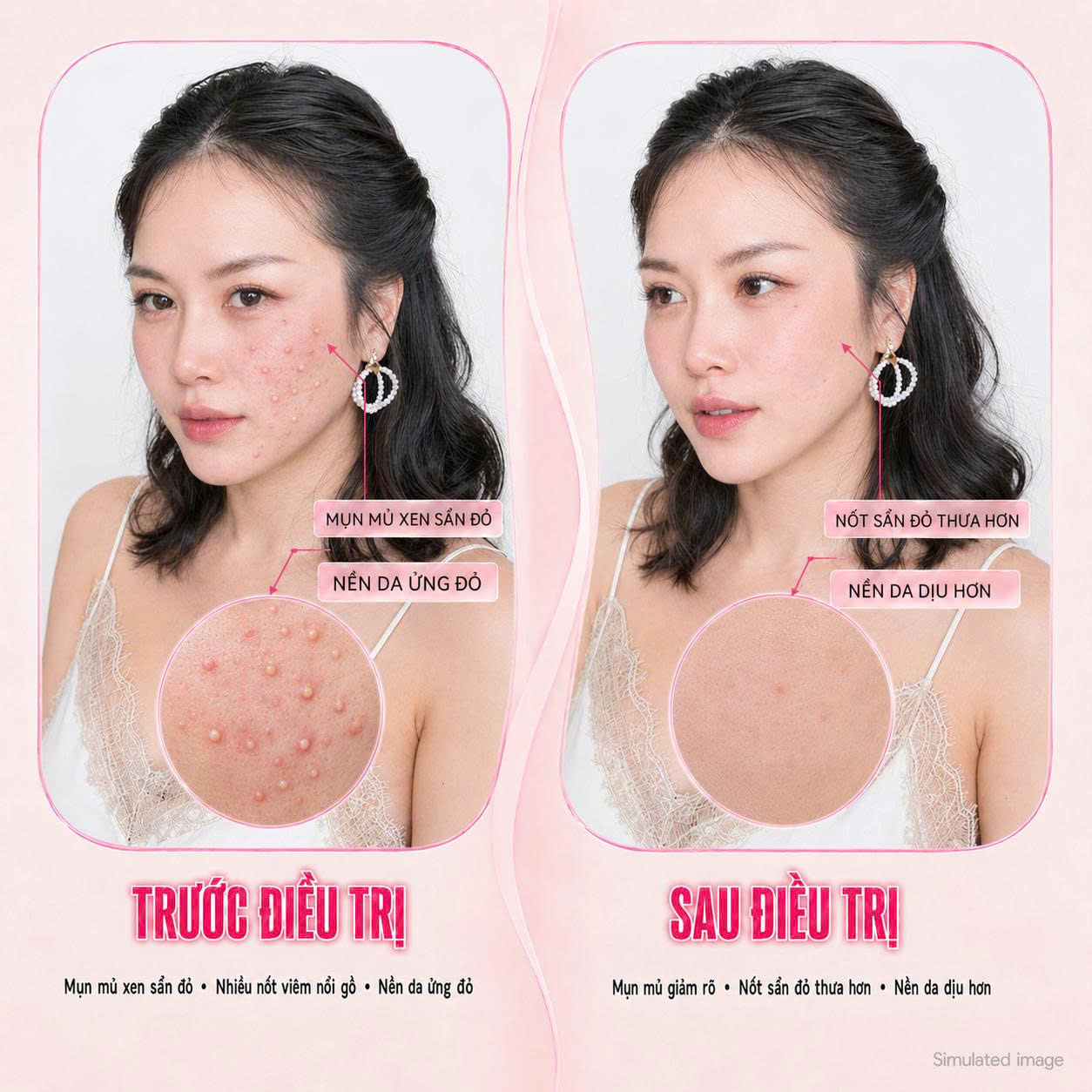Trị Mụn Mủ Trị Mụn Mủ