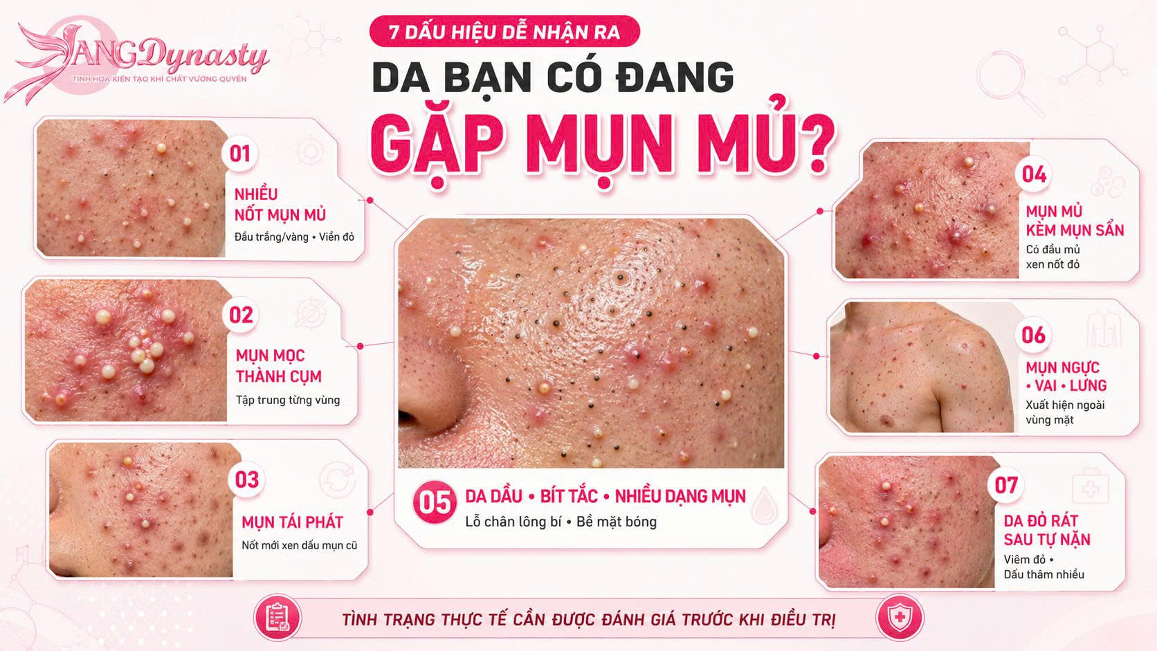 Trị Mụn Mủ Trị Mụn Mủ