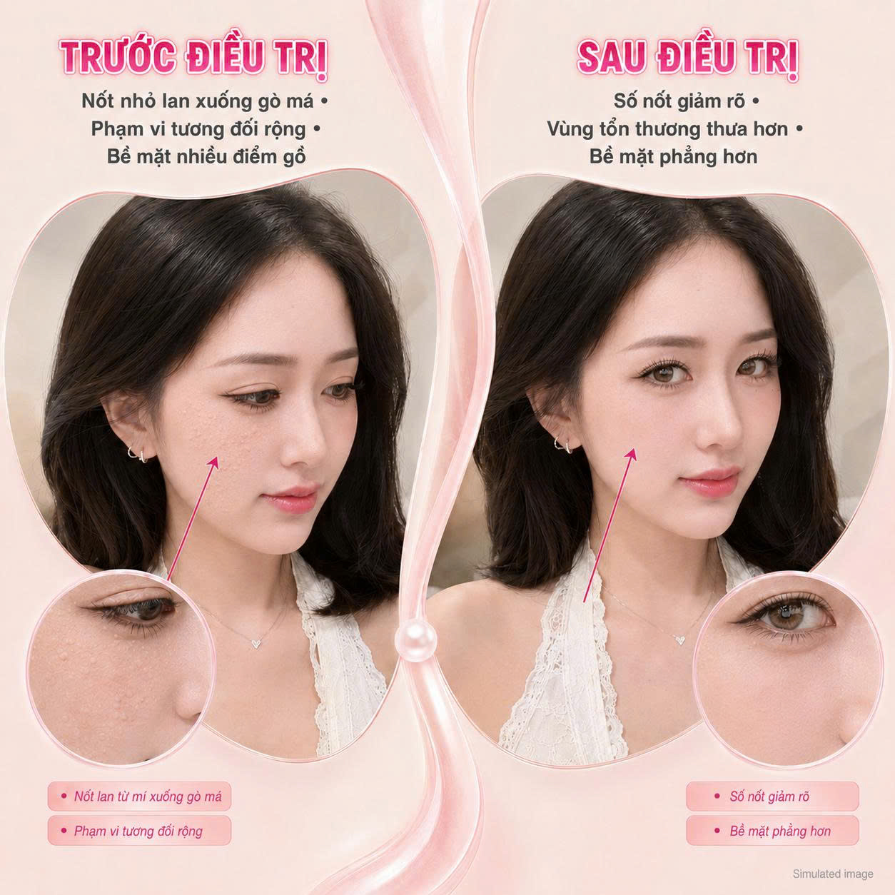 Trị Mụn Thịt Trị Mụn Thịt