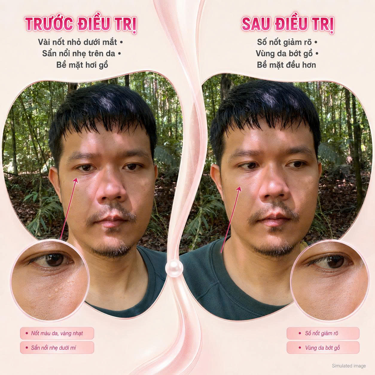 Trị Mụn Thịt Trị Mụn Thịt