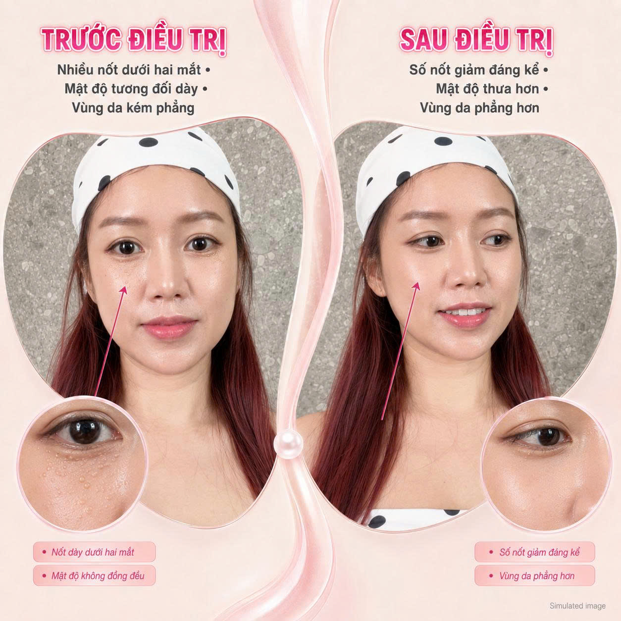 Trị Mụn Thịt Trị Mụn Thịt