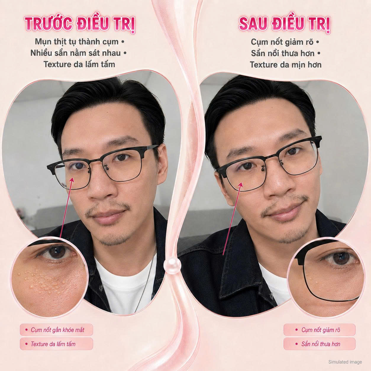 Trị Mụn Thịt Trị Mụn Thịt