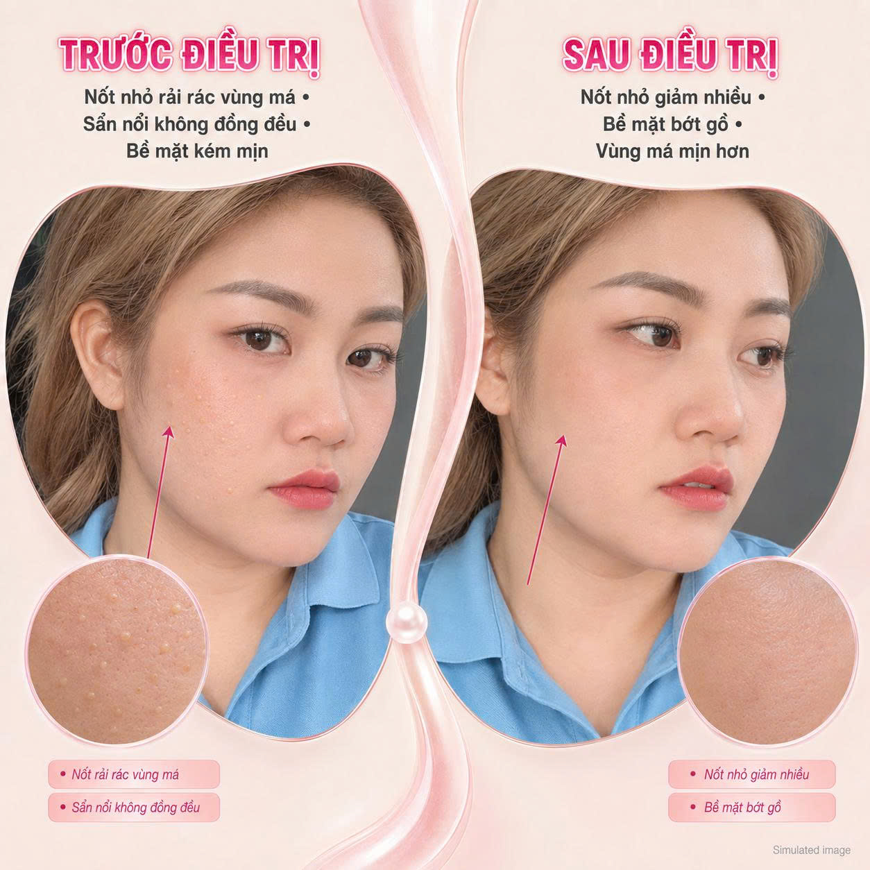 Trị Mụn Thịt Trị Mụn Thịt