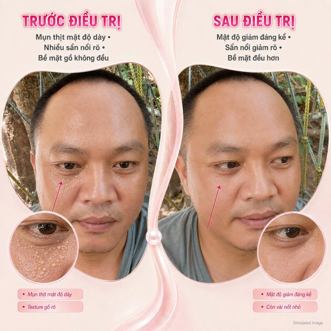 Trị Mụn Thịt Trị Mụn Thịt