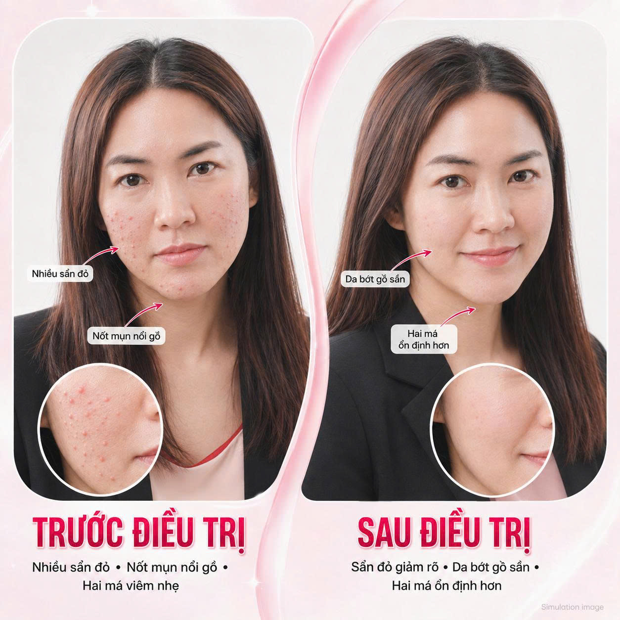 Trị Mụn Trứng Cá Trị Mụn Trứng Cá