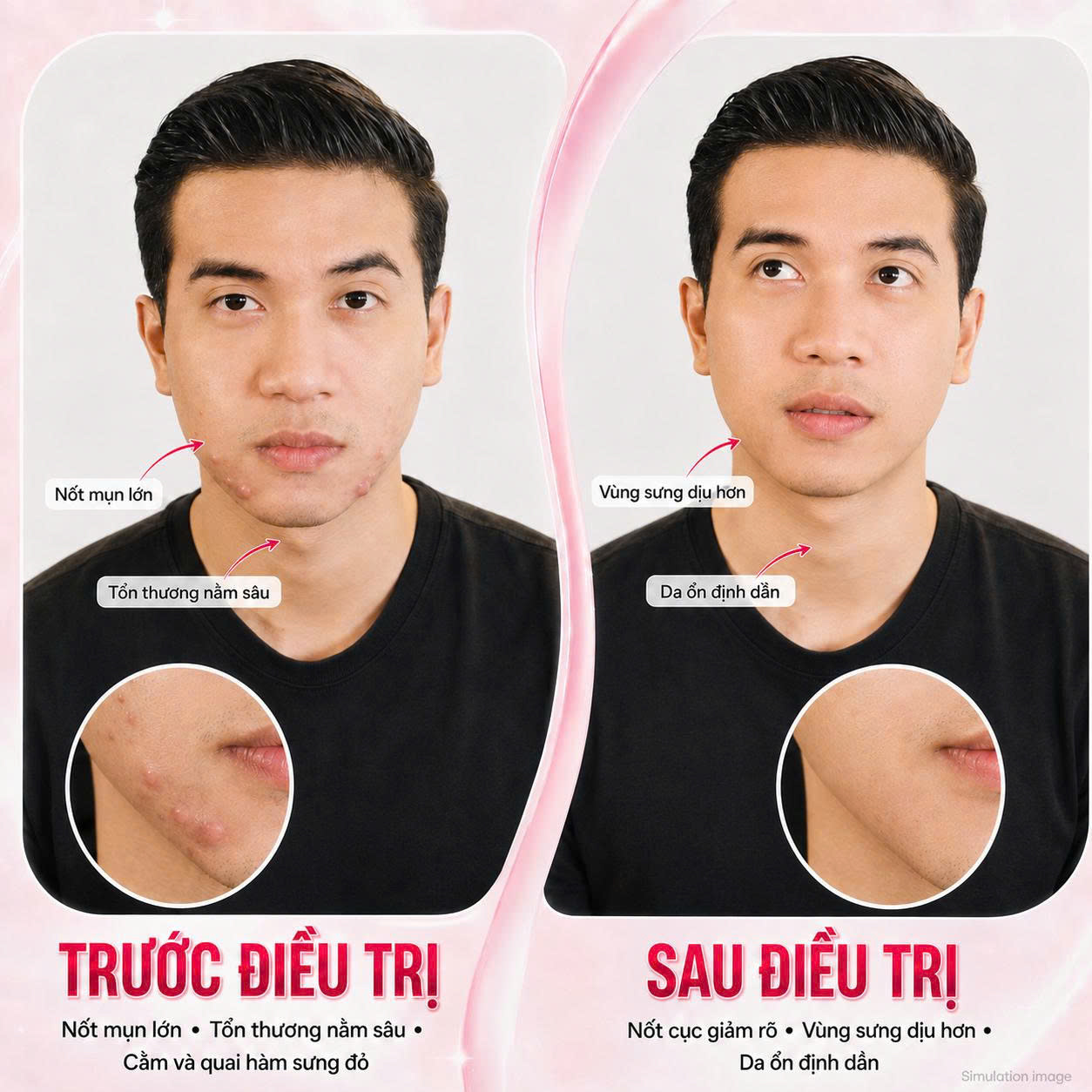 Trị Mụn Trứng Cá Trị Mụn Trứng Cá