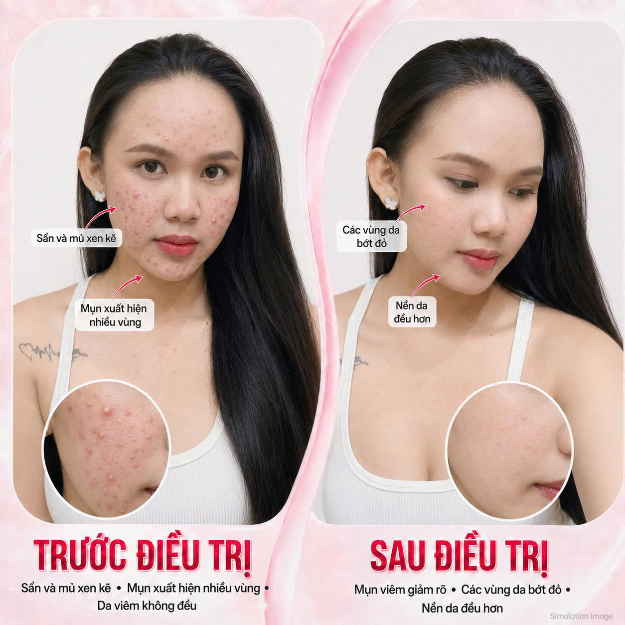 Trị Mụn Trứng Cá Trị Mụn Trứng Cá