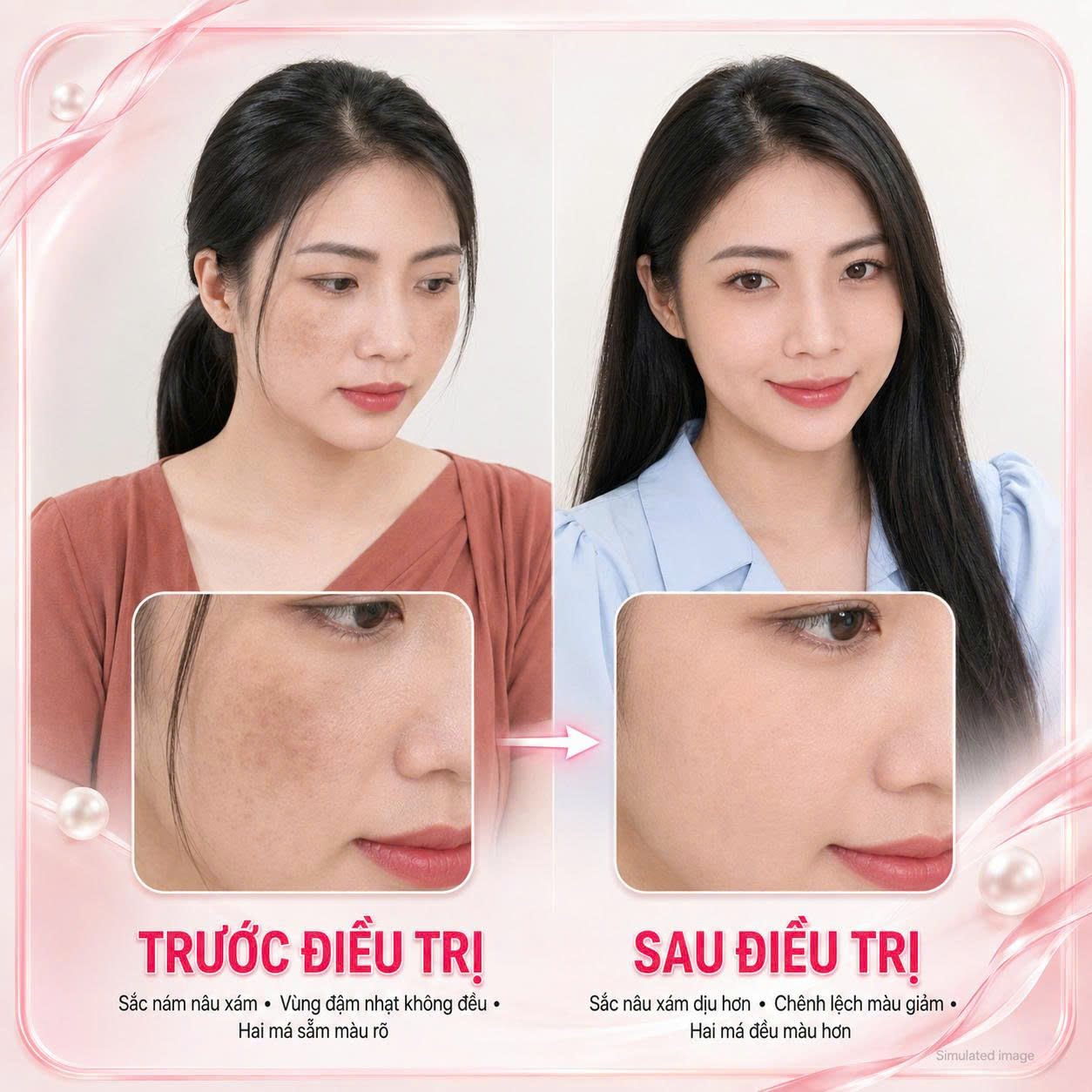 YANG Dynasty Trị Nám Da Case 02