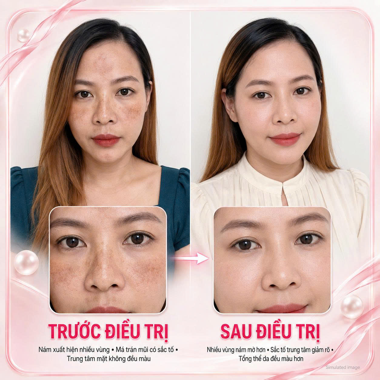 YANG Dynasty Trị Nám Da Case 04