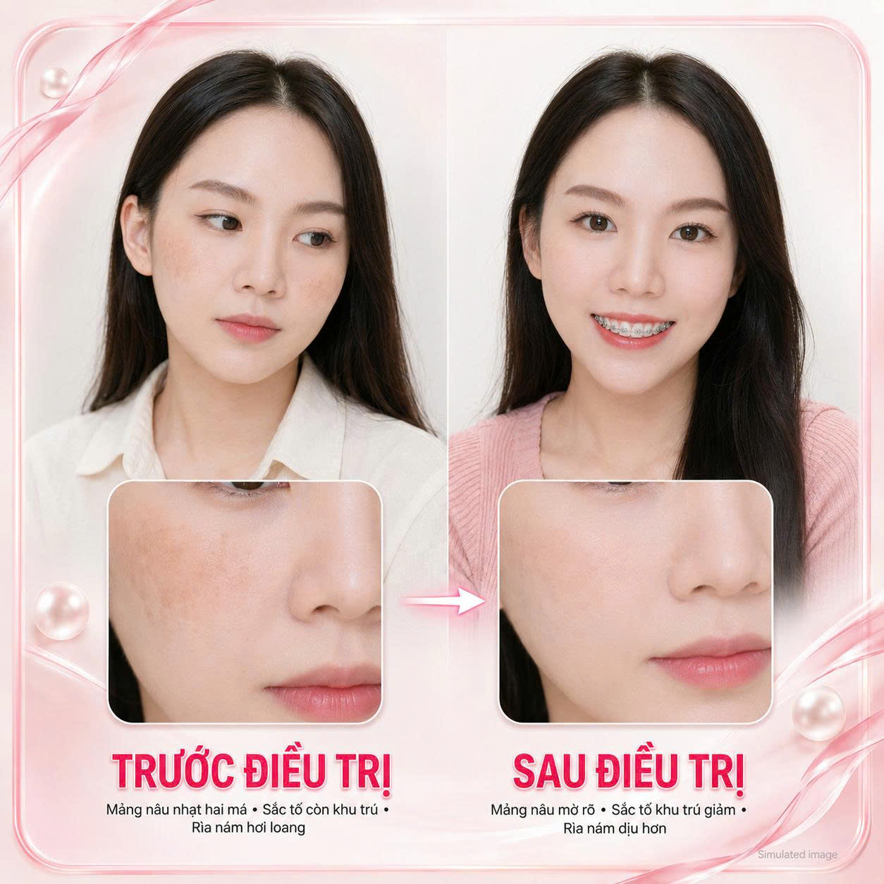 YANG Dynasty Trị Nám Da Case 05