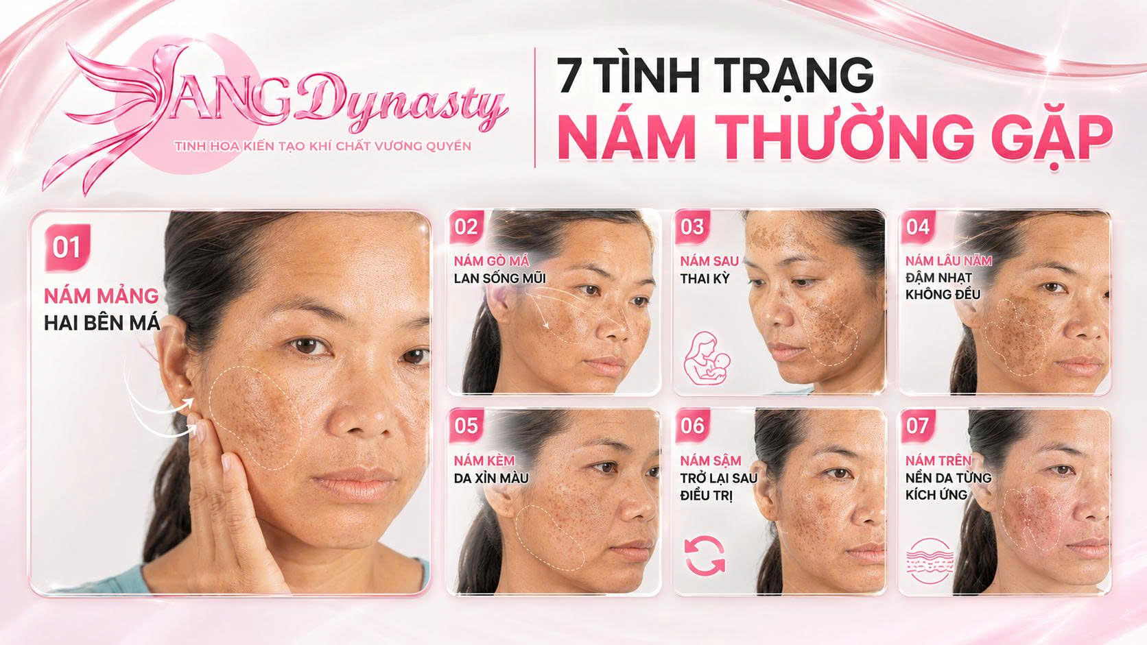 Trị Nám Da