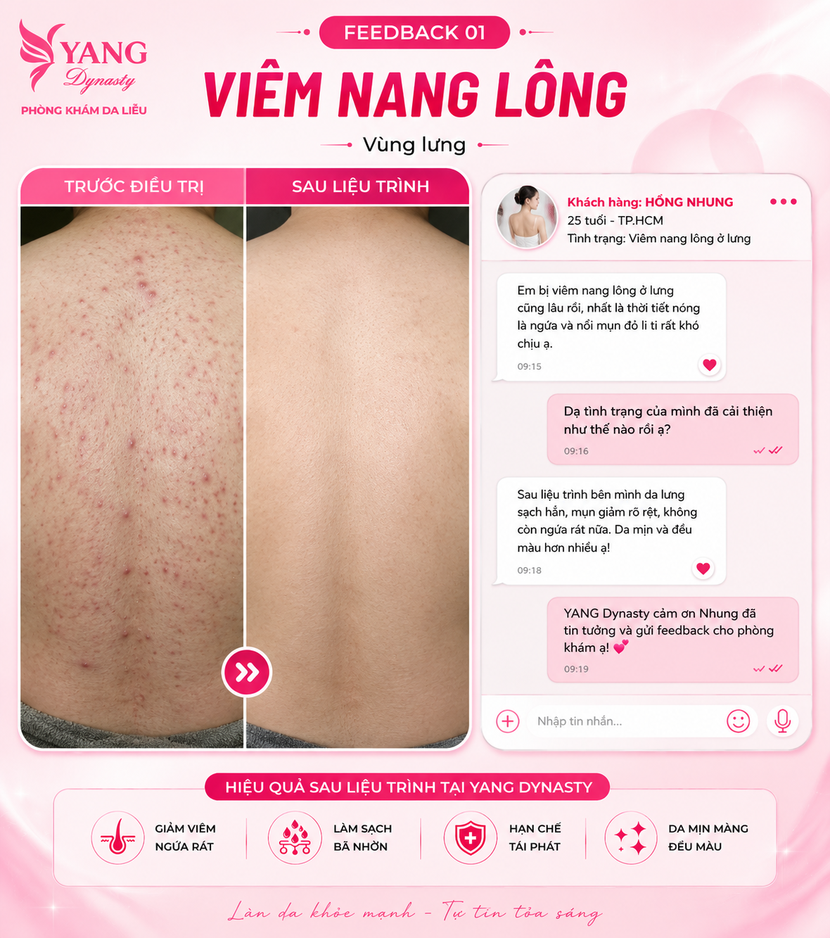 Feedback điều trị viêm nang lông YANG Dynasty 01