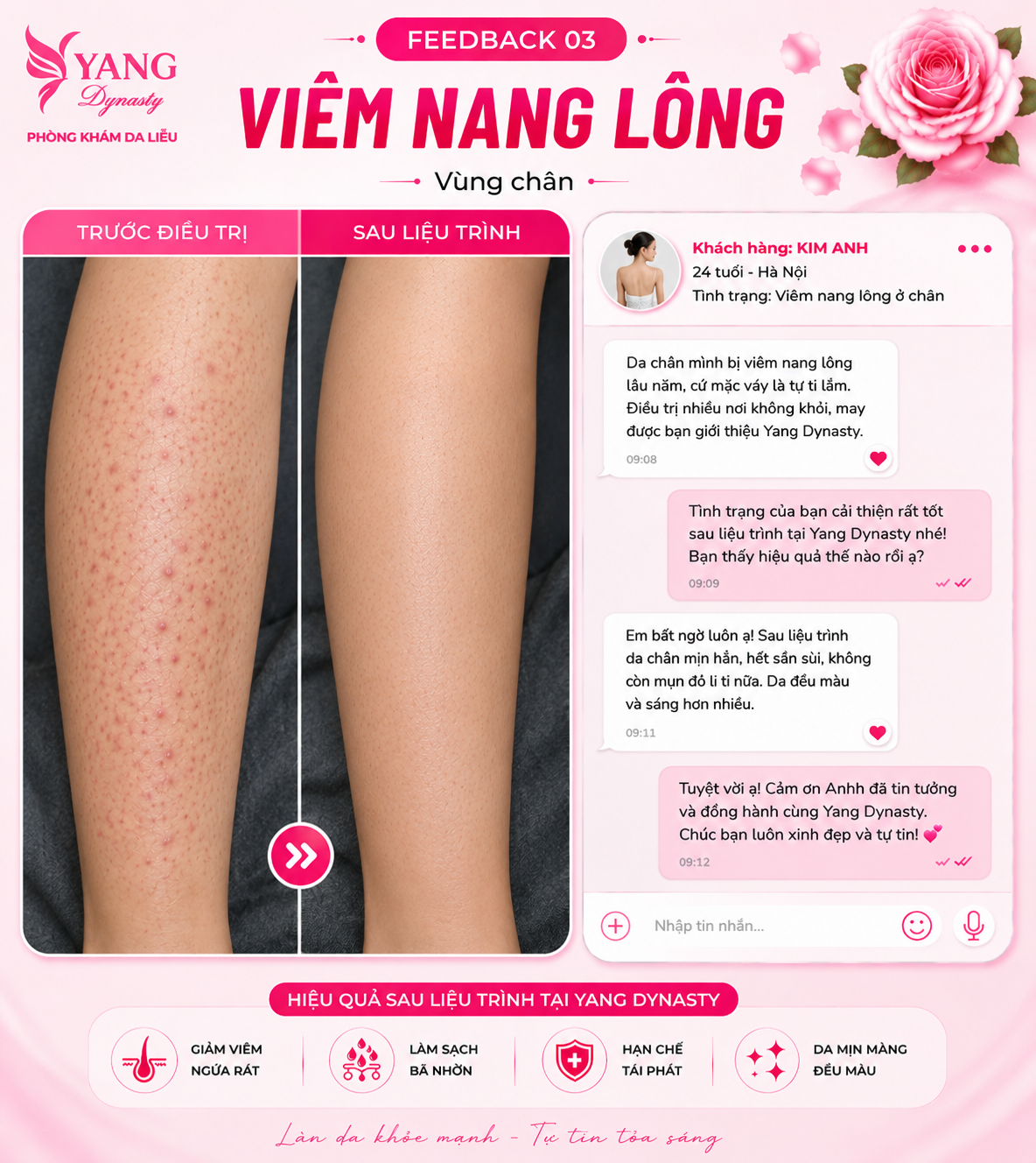 Feedback điều trị viêm nang lông YANG Dynasty 03