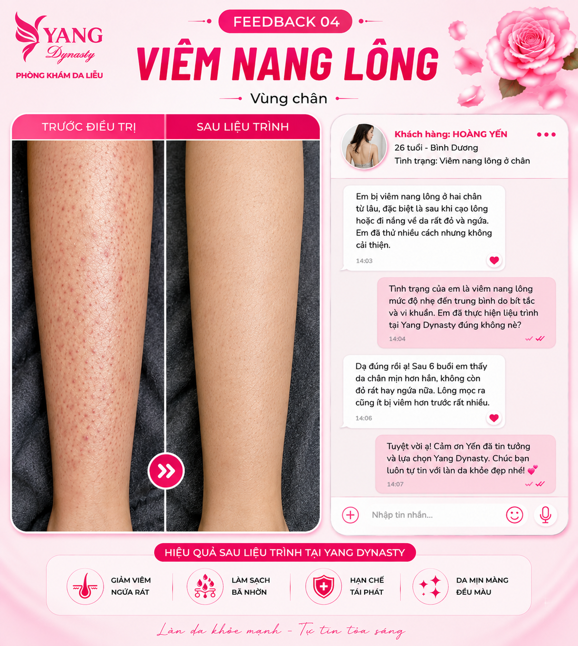 Feedback điều trị viêm nang lông YANG Dynasty 04