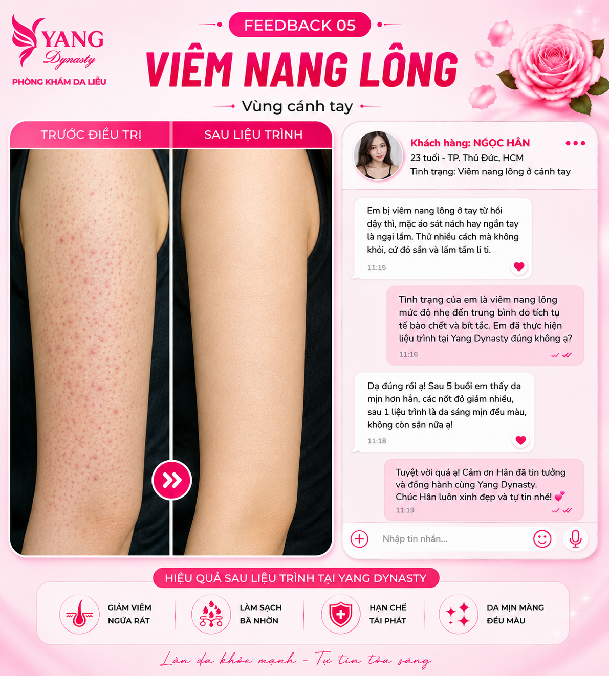 Feedback điều trị viêm nang lông YANG Dynasty 05