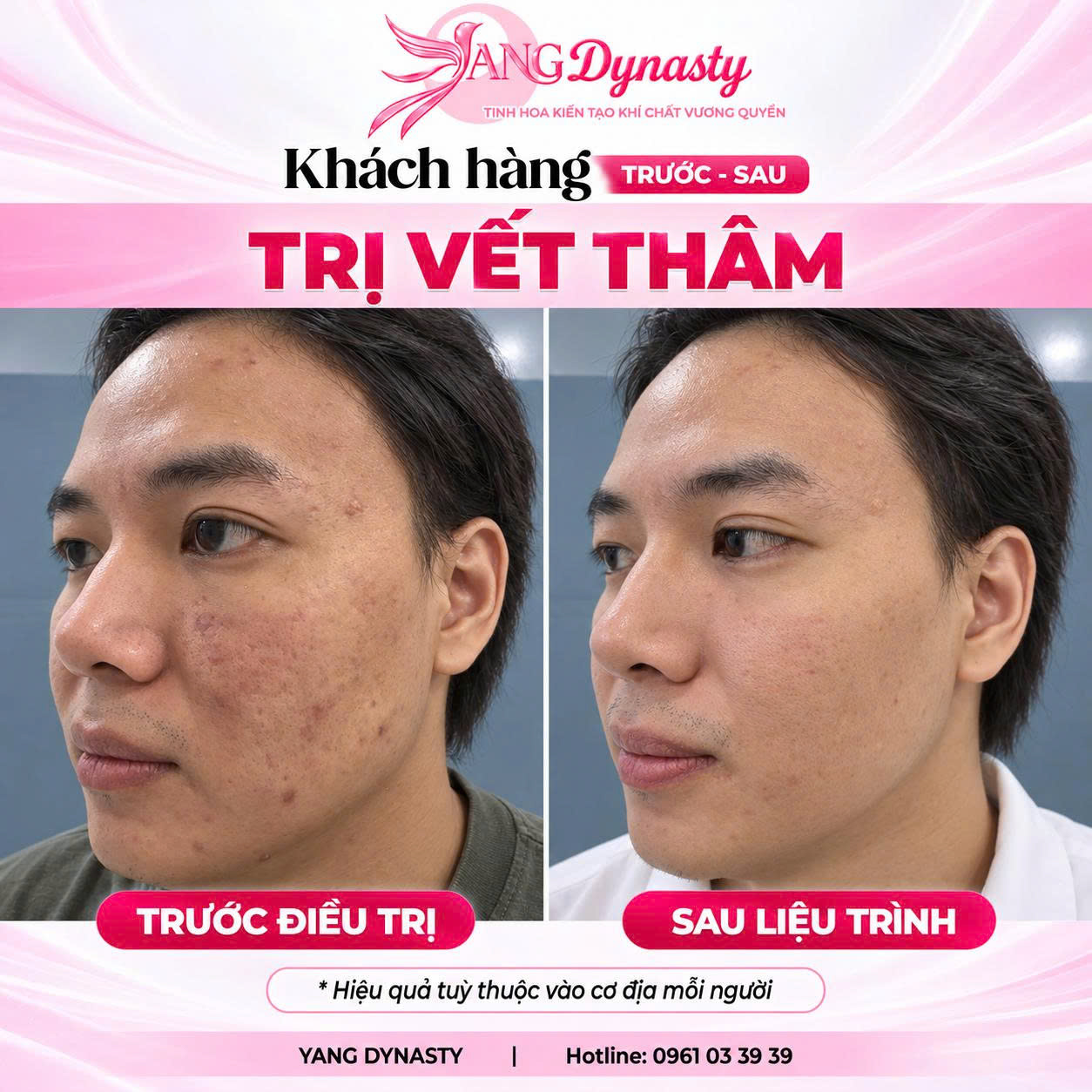 Trị Vết Thâm