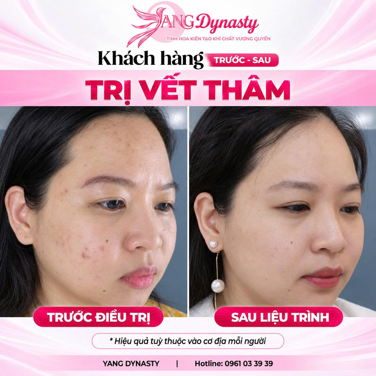 Trị Vết Thâm
