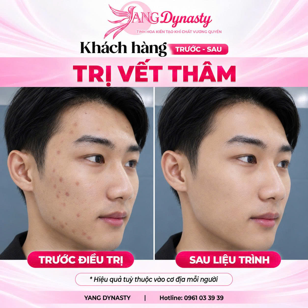 Trị Vết Thâm