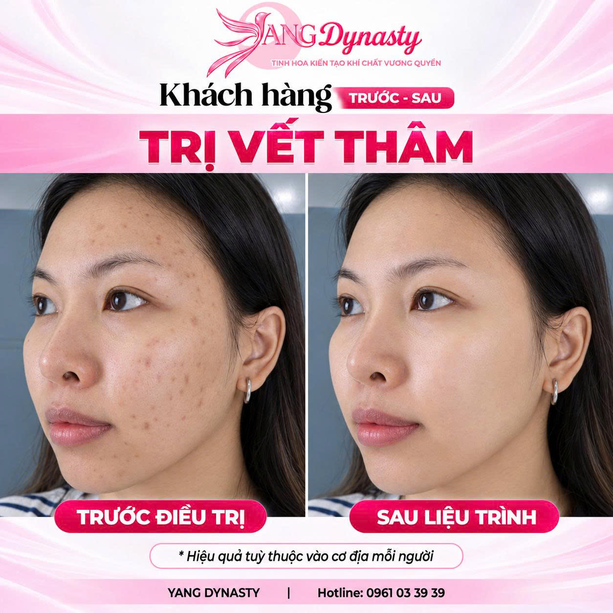 Trị Vết Thâm