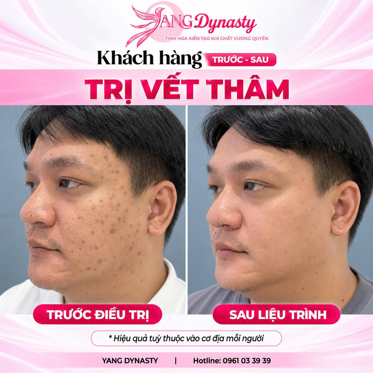 Trị Vết Thâm
