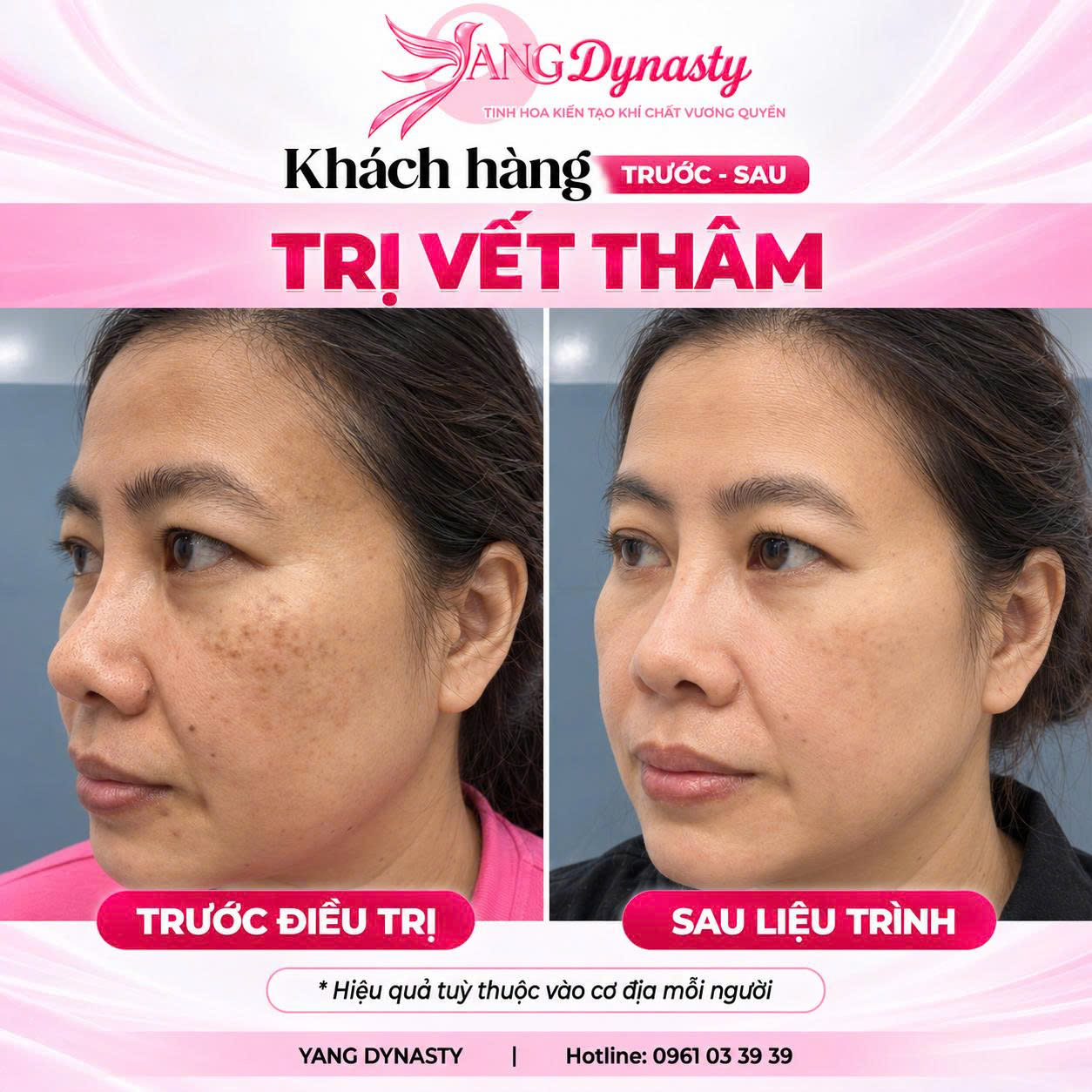 Trị Vết Thâm