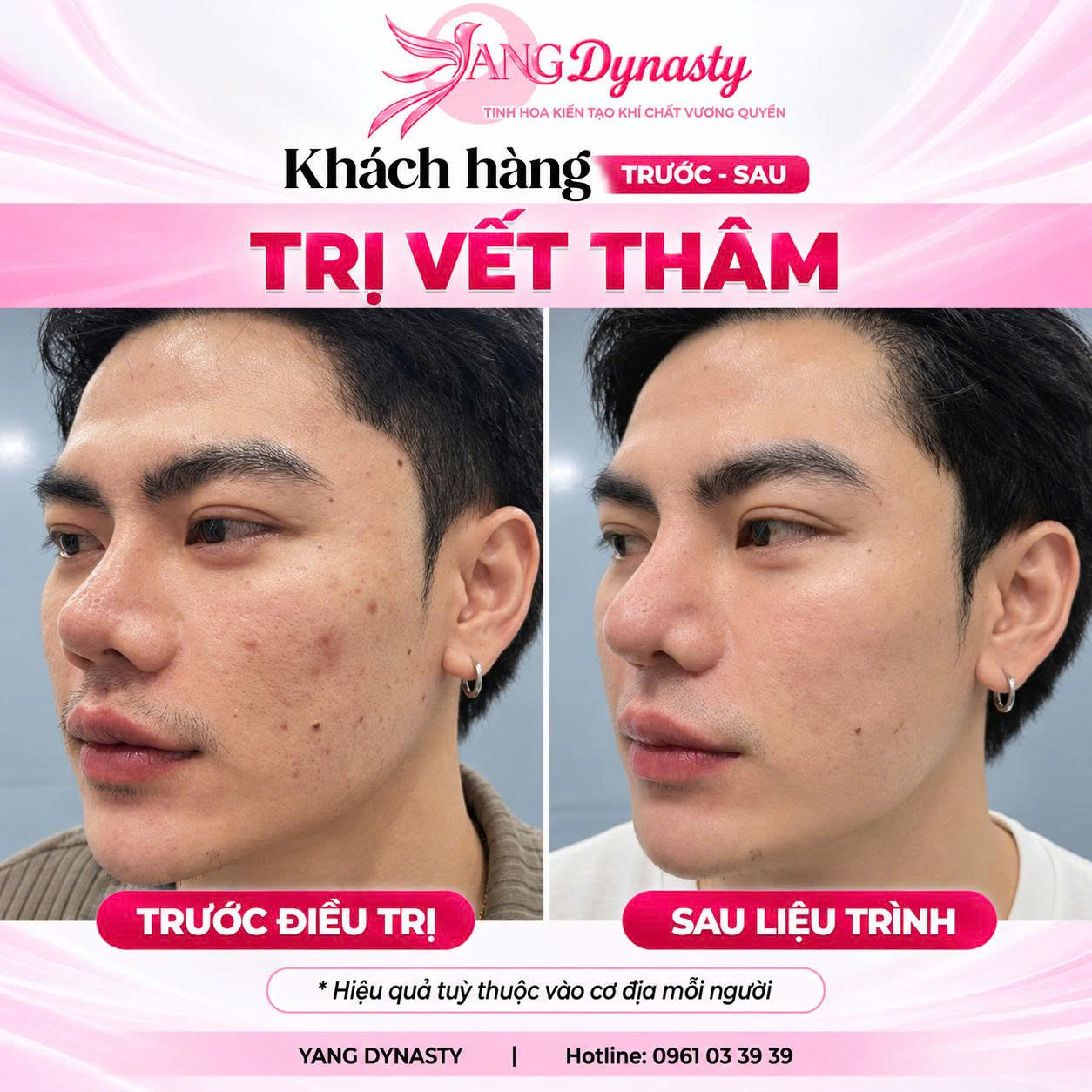 Trị Vết Thâm