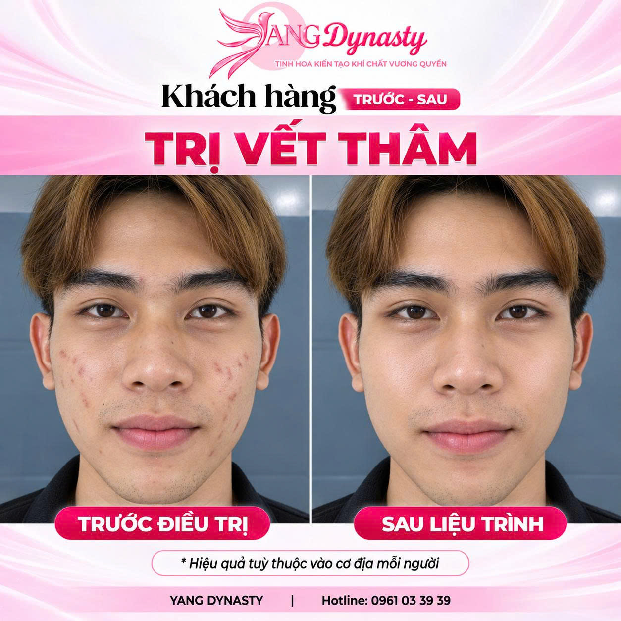Trị Vết Thâm
