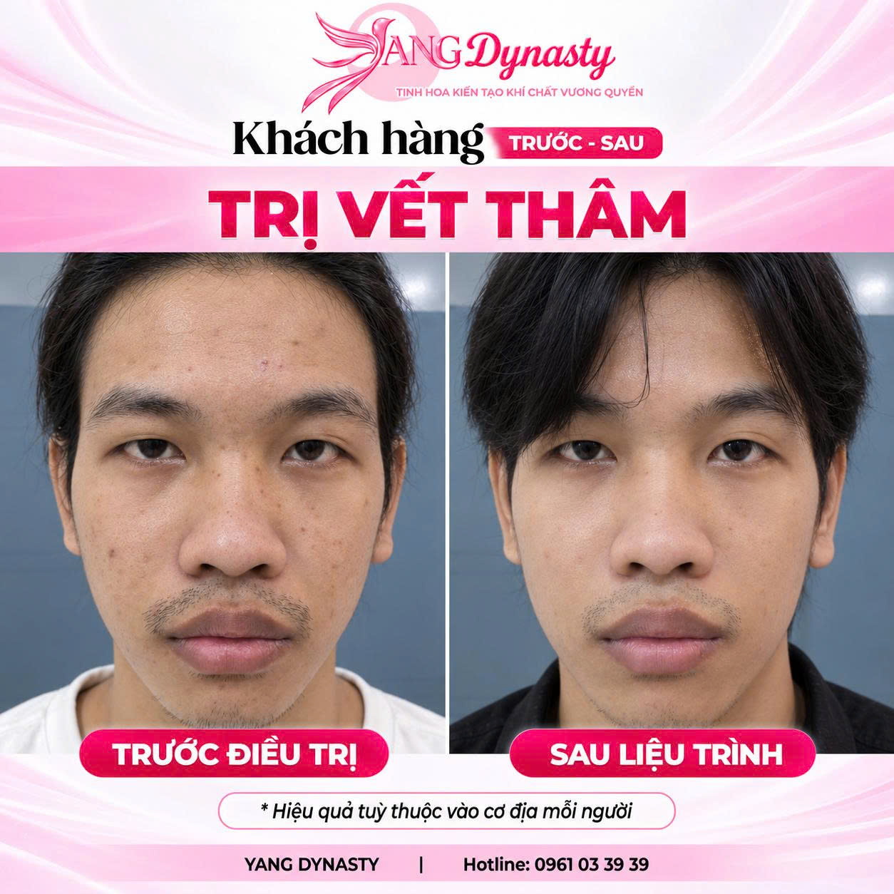 Trị Vết Thâm